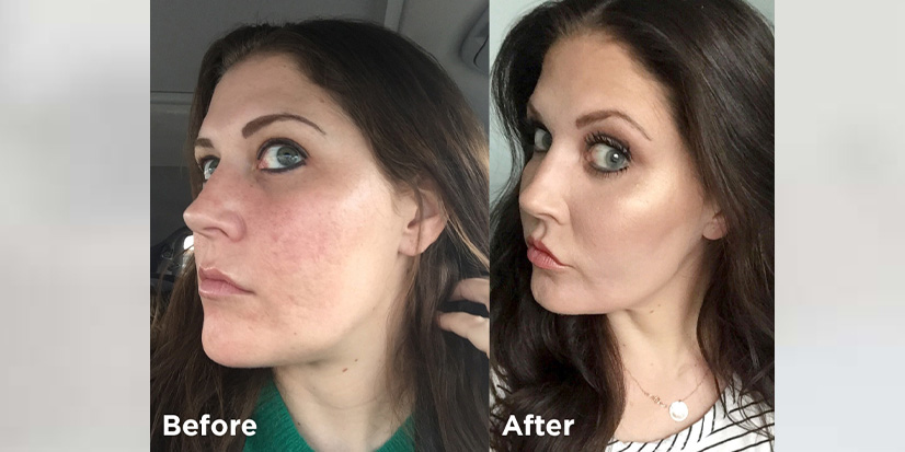CO2 Laser Resurfacing Before & After Pictures