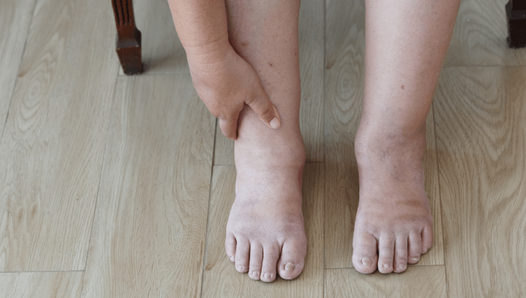 Swollen Ankles And Feet Here Are Common Causes Solutions Healthy You