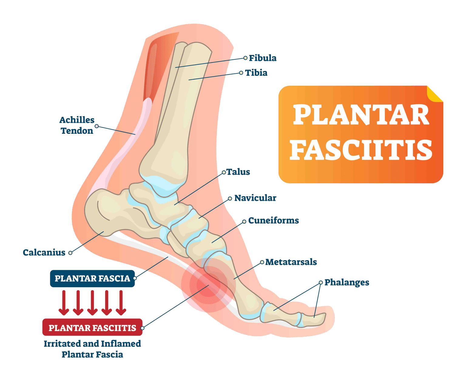 Causes of Heel Pain | The Podiatry Group of South Texas